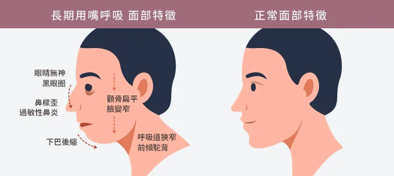 一名兒童張口呼吸的側臉示意插圖,用於說明長期口呼吸與顎面發育的衛教關聯